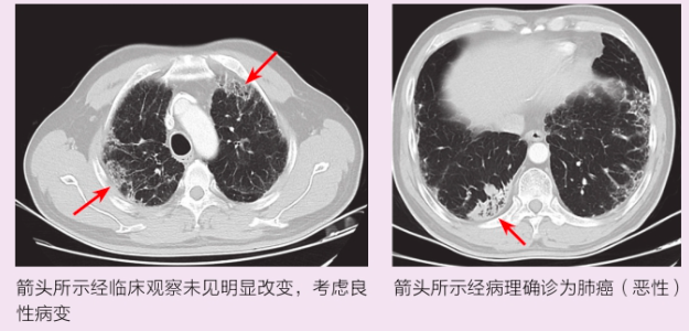 肺纤维化和肺癌图对比