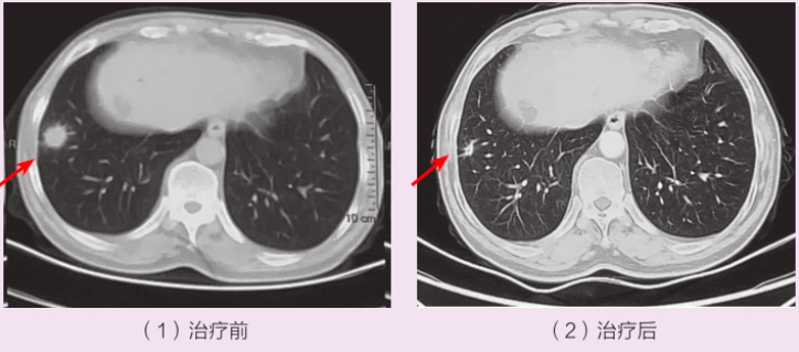 肺占位性病变吃药可以消灭吗？肺占位性病变的治疗误区