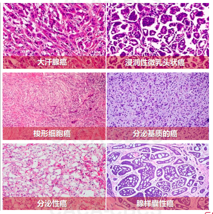 大汗腺分化的癌,浸润性微乳头状癌,化生性癌,分泌性癌,腺样囊性癌