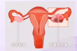 加入2026卵巢癌病友群，携手共渡难关