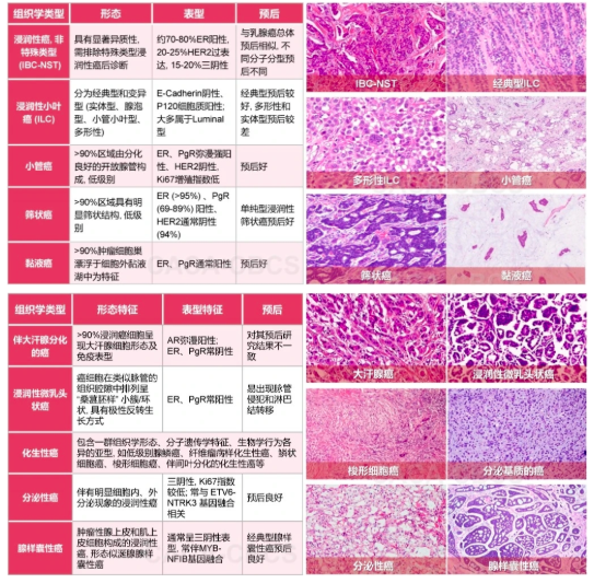  浸润性乳腺癌（IBC）常见类型介绍