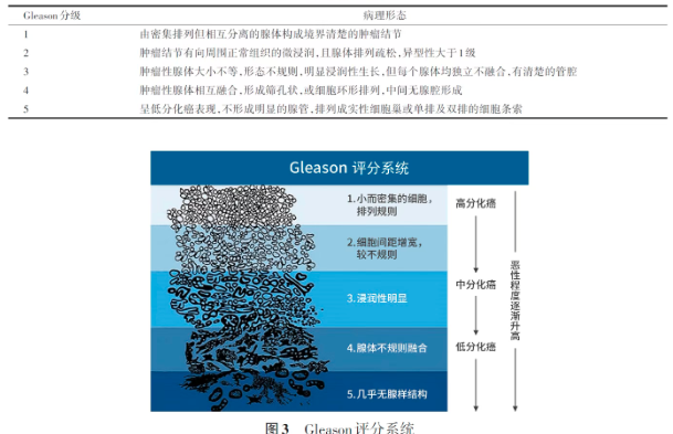 Gleason评分系统