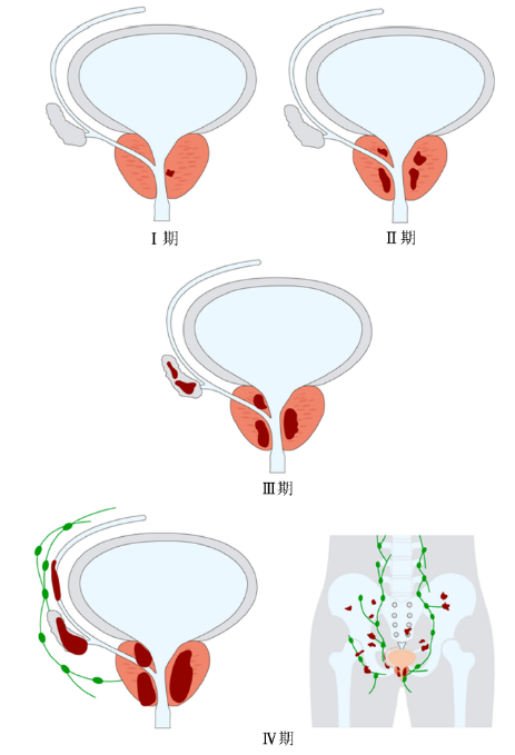 前列腺癌分期示意图